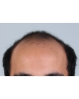 Before Hair Transplant &nbsp;Front